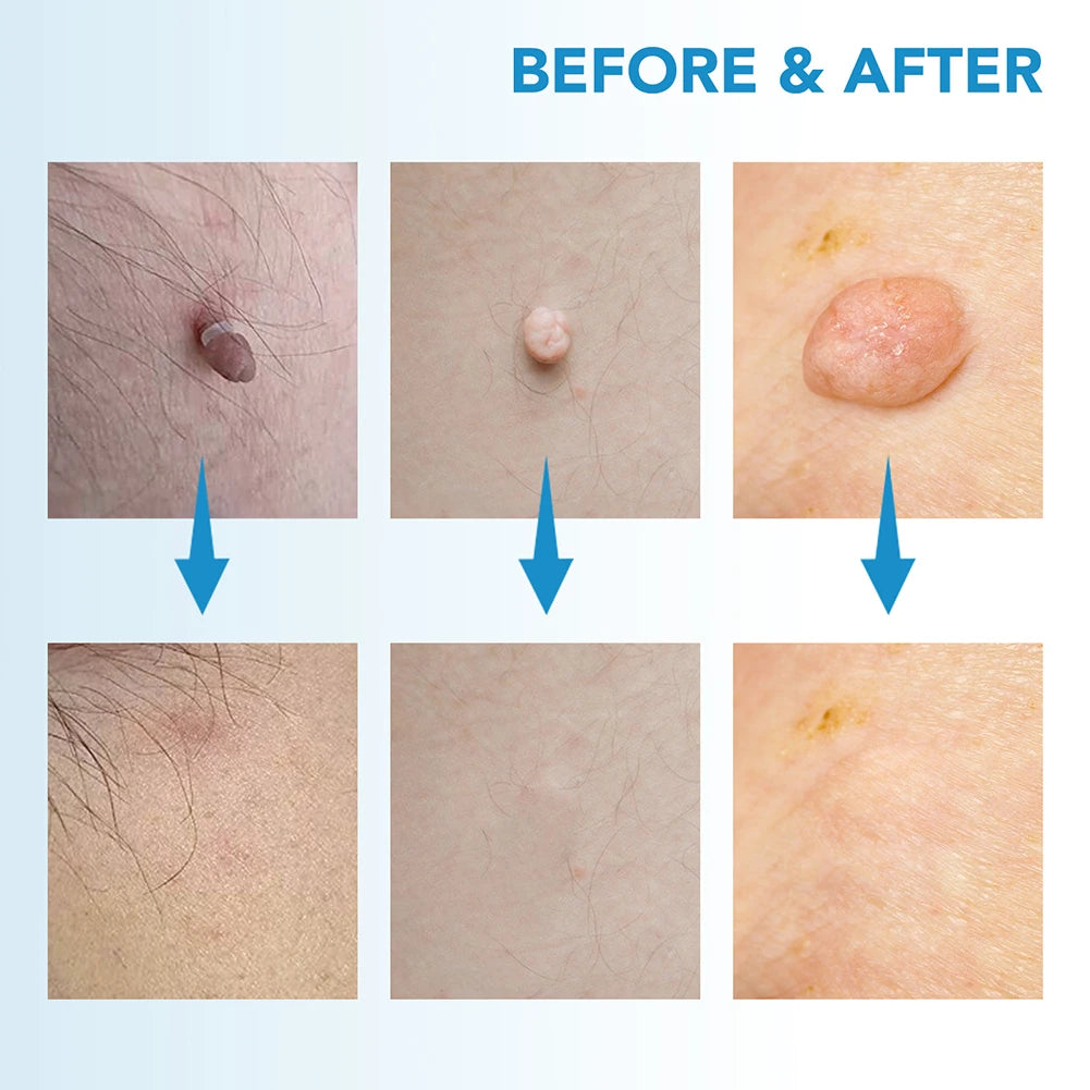 2 IN 1 Auto Micro Skin Tag Remover Device Standard And Micro Skin Tag Removal Kit Adult Mole Wart Remover Face Care Beauty Tools