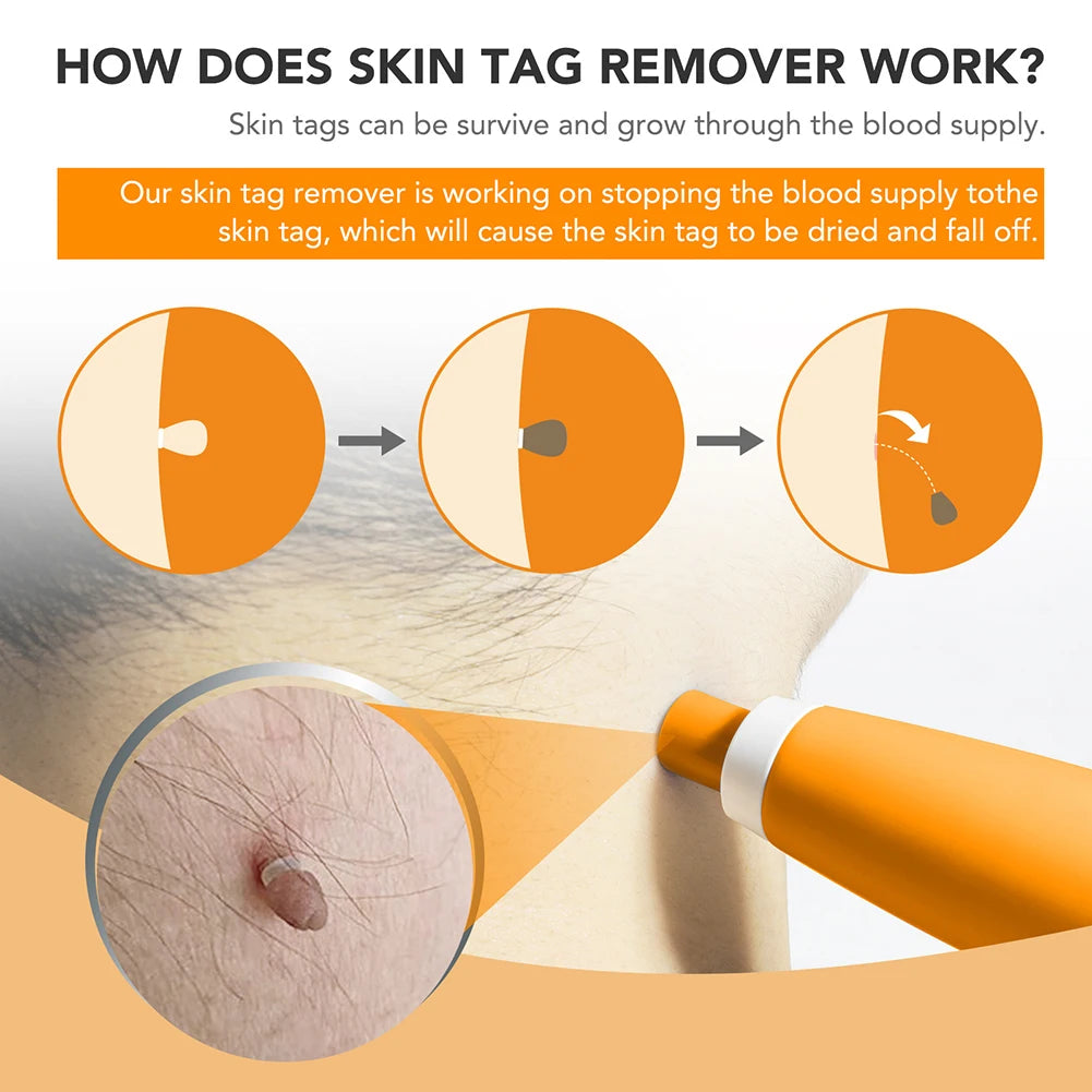 2 IN 1 Auto Micro Skin Tag Remover Device Standard And Micro Skin Tag Removal Kit Adult Mole Wart Remover Face Care Beauty Tools