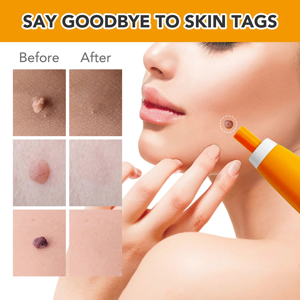 2 IN 1 Auto Micro Skin Tag Remover Device Standard And Micro Skin Tag Removal Kit Adult Mole Wart Remover Face Care Beauty Tools