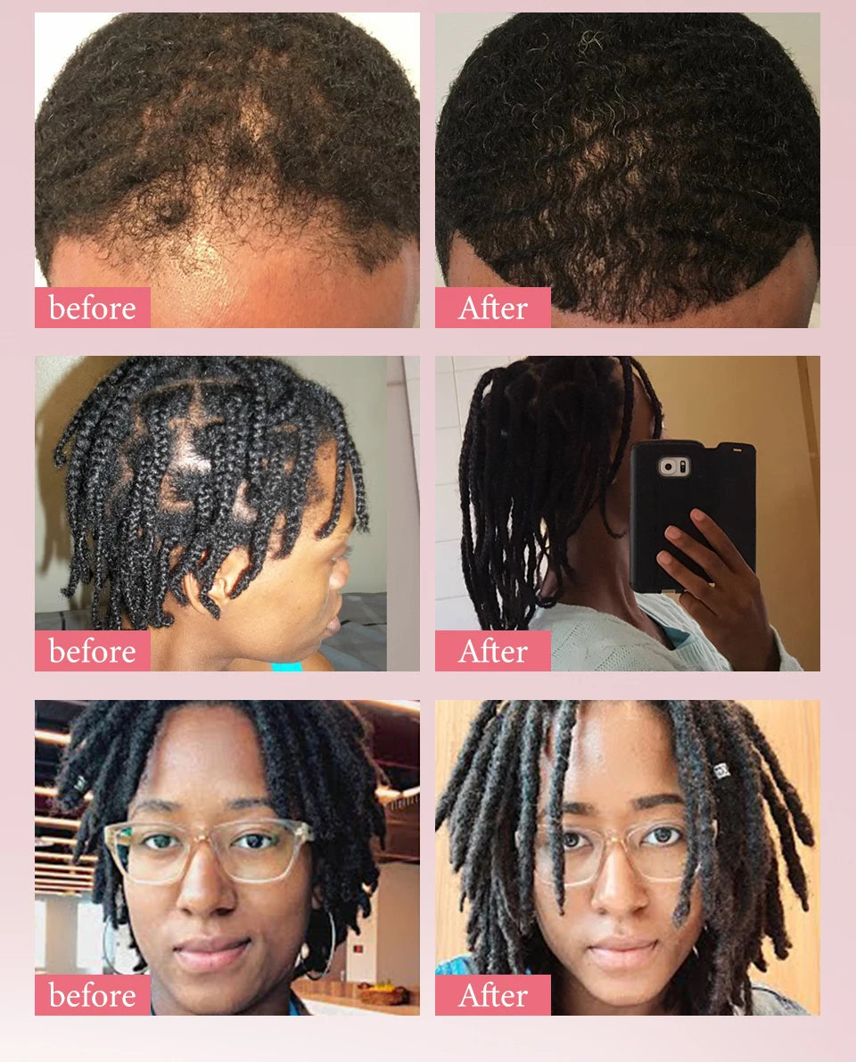 Fast Hair Growth Set Batana Oil Traction Alopecia Hair Mask Anti Break Loss Hair Growth Oil Baldness Treatment Hair Health Care