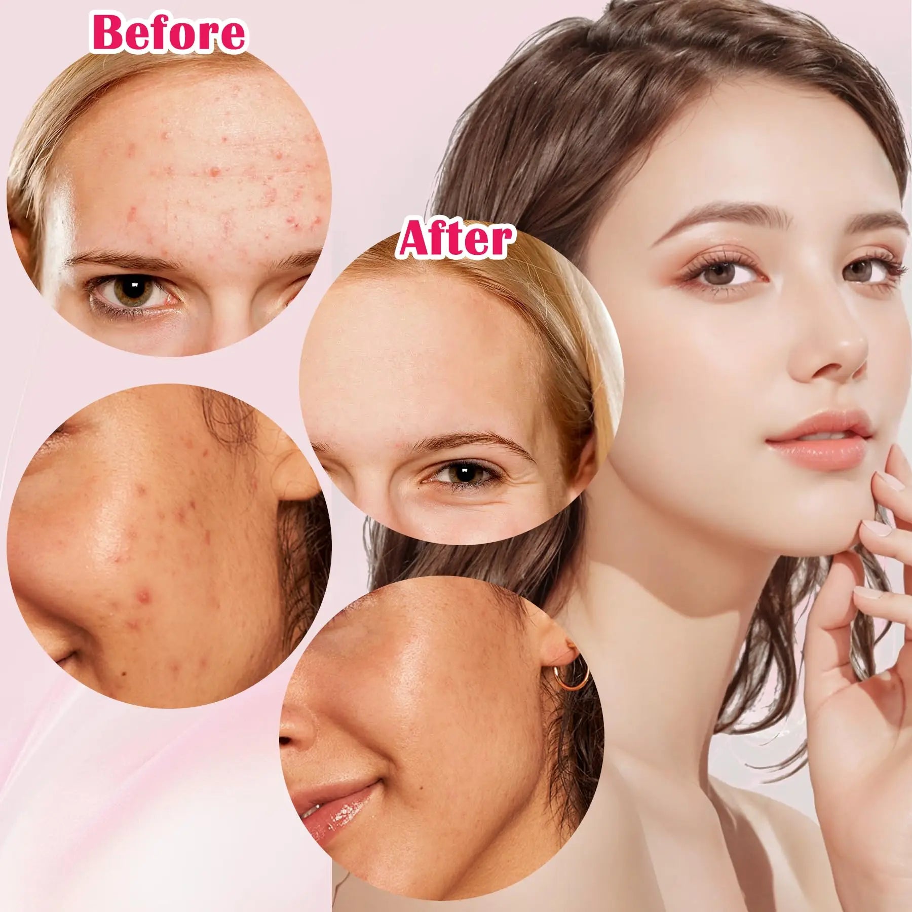 Silver 4-Pack Blackhead Remover Comedones Extractor Removal Kit - For Blemishes, Whiteheads Removal Facial Skin Care (With Box)