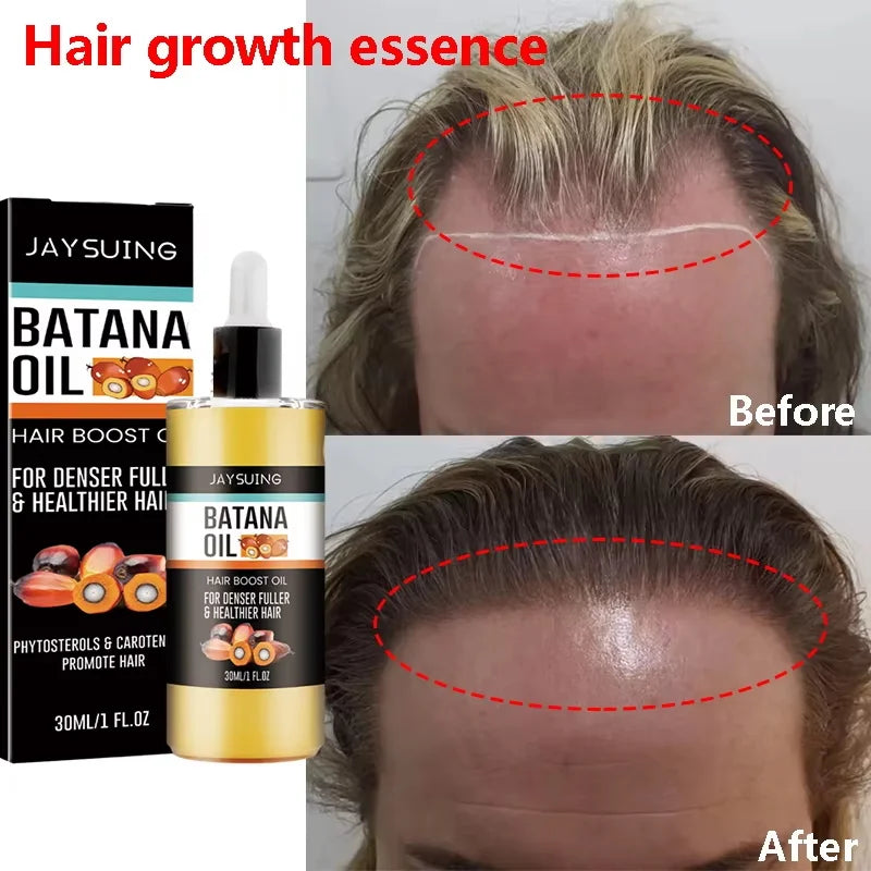 Jaysuing Fast Hair Growth Set – Batana Oil & Hair Mask for Traction Alopecia, Anti-Breakage & Baldness Repair (30ml)