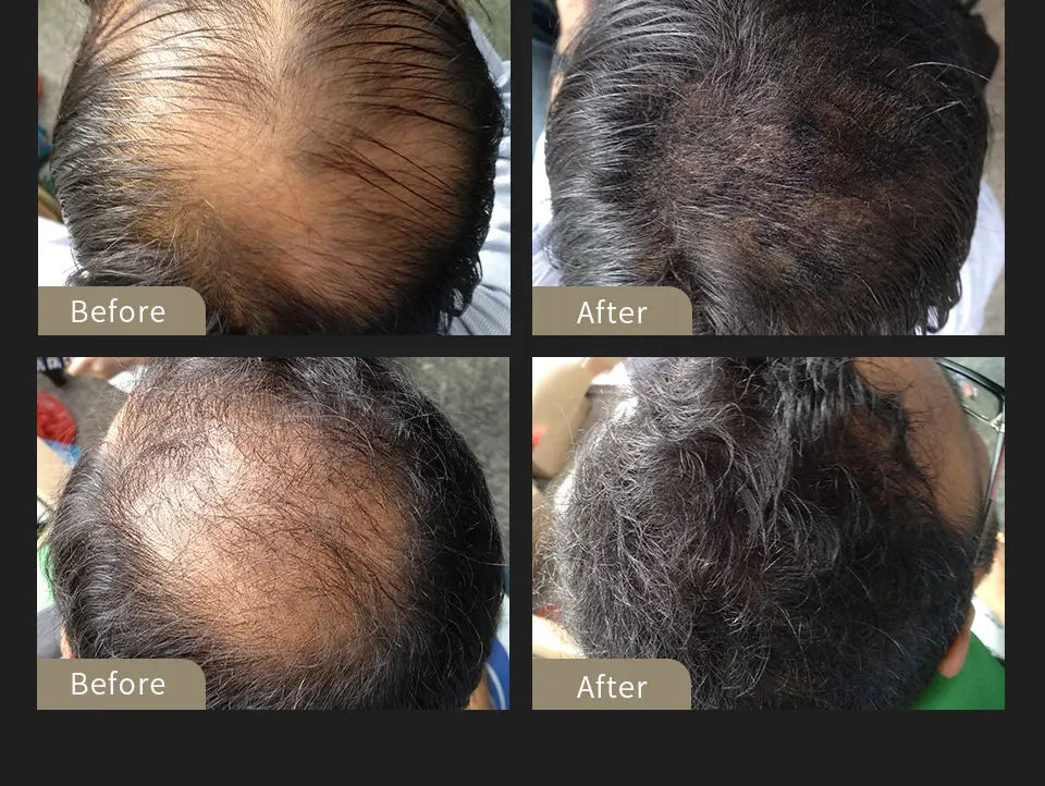 SEVICH Keratin Hair Fiber Set – Covers Sparse Hair & Bald Spots (25g)